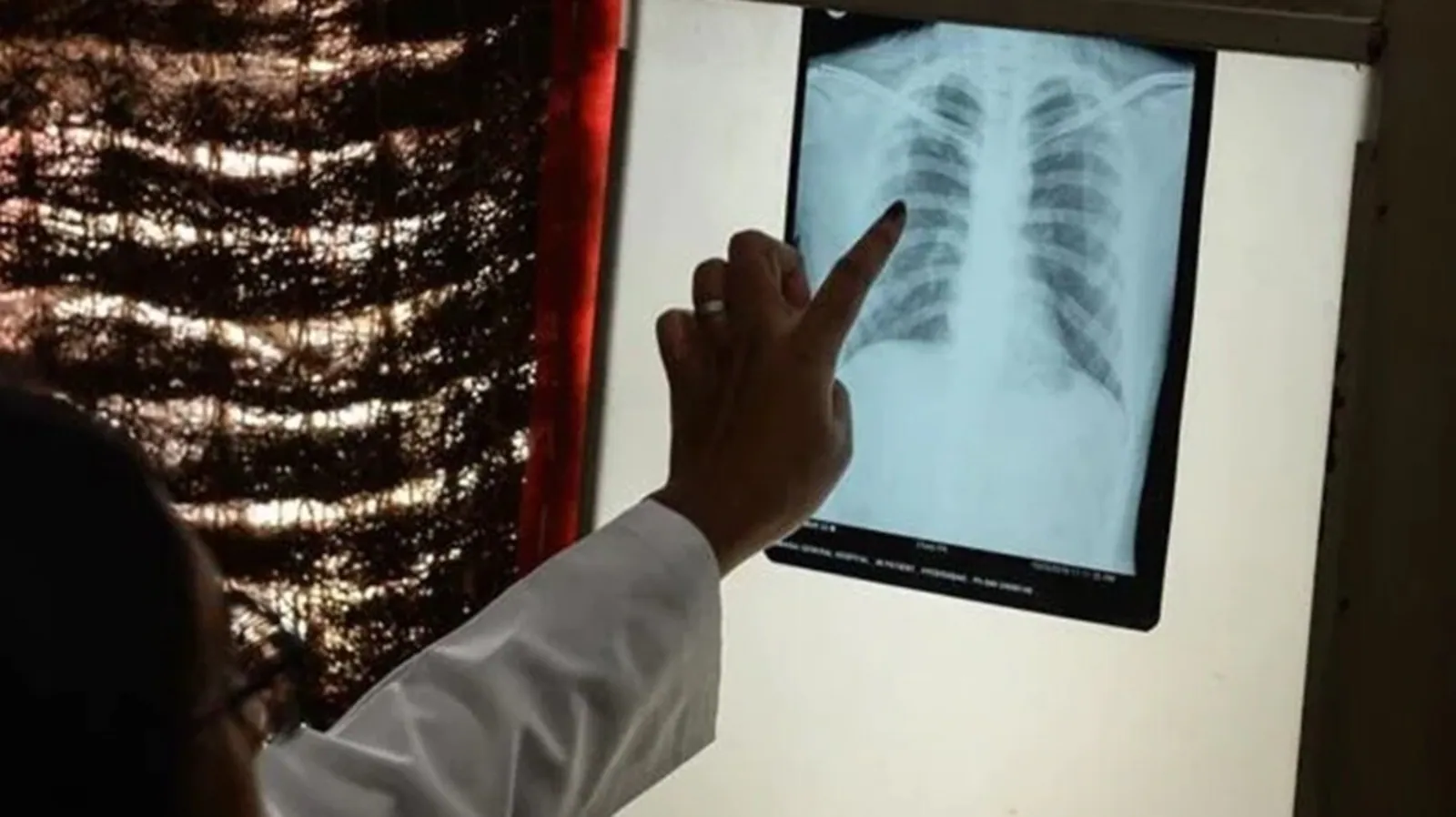 World Tuberculosis Day 2022: Do not ignore these common symptoms of TB
